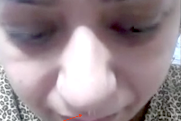 Quick recovery in 3 days- Case of CSF Rhinorrhea from Patiala